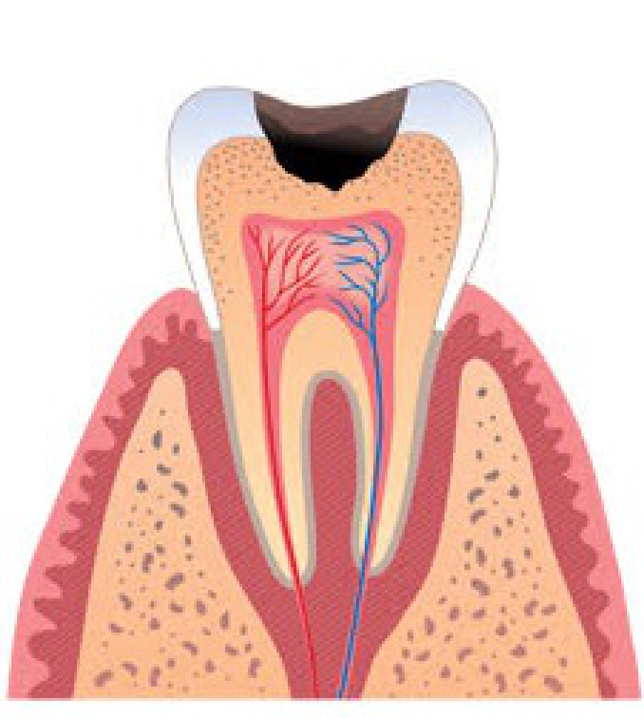 Глубокий кариес